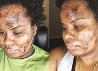 What’s the Deal with Skin Bleaching and How is it Still Happening?