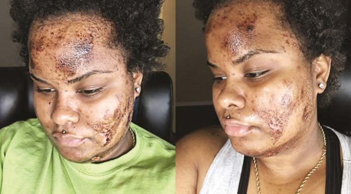 What’s the Deal with Skin Bleaching and How is it Still Happening?